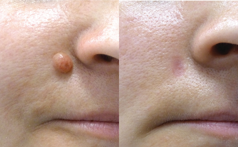mole removal in dubai