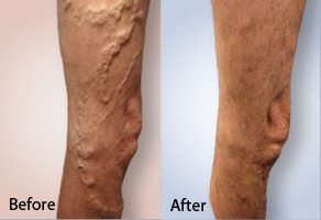 before and after photo of varicose vein treatment on the leg of patient